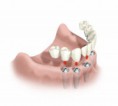 /album/fotos/a66524123-2-clinica-medico-dentaria-da-prelada-implantes-dentarios-e-ortodontia-porto-jpg1/